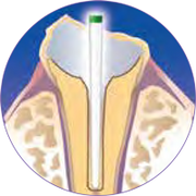 Dental Cure-Thru® IntegraPost® - Zirconia Glass Fiber Posts 10/pk - Premier Dental - Dentamed USA