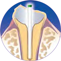 Dental Cure-Thru® IntegraPost® - Zirconia Glass Fiber Posts 10/pk - Premier Dental - Dentamed USA