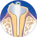 Dental Cure-Thru® IntegraPost® - Zirconia Glass Fiber Posts 10/pk - Premier Dental - Dentamed USA